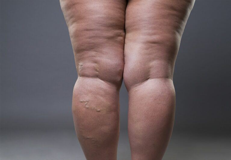 Be Set Free from Edema